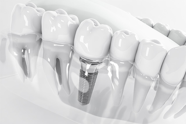 口腔外科専門医が行う、高度で精密なインプラント治療