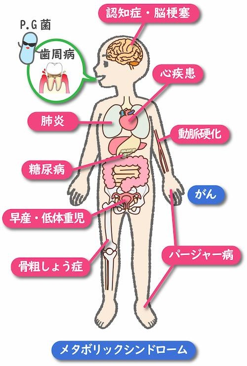 全身疾患と歯周病